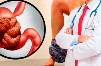 Gemorroy va to‘g‘ri gigiyena: Nima qilish kerak?