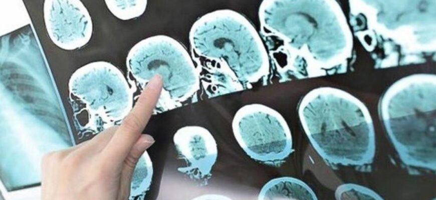Dünya nüfusunun yüzde 43,1'i nörolojik hastalıklardan muzdarip